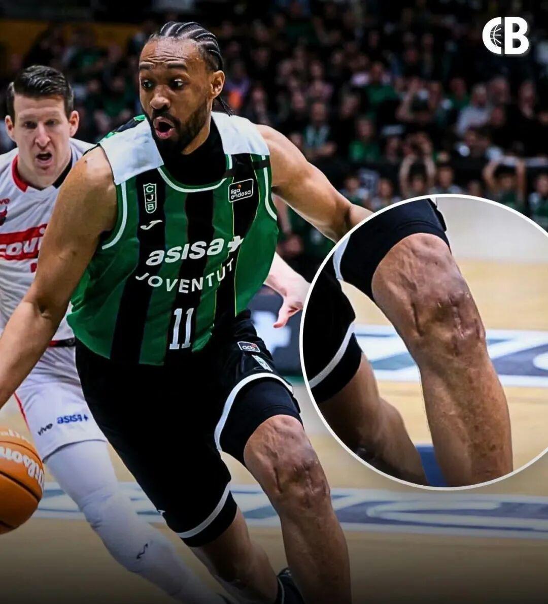 世界杯高清平台-好可怕的膝盖！两次ACL撕裂，他还在打球！！！